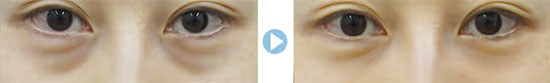 ガーデンクリニックのニュープレミアムオートファイバー＋下瞼脱脂法の症例