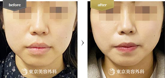 東京美容外科のエラボトックス注射による小顔・輪郭整形（ボツリヌストキシン）の症例