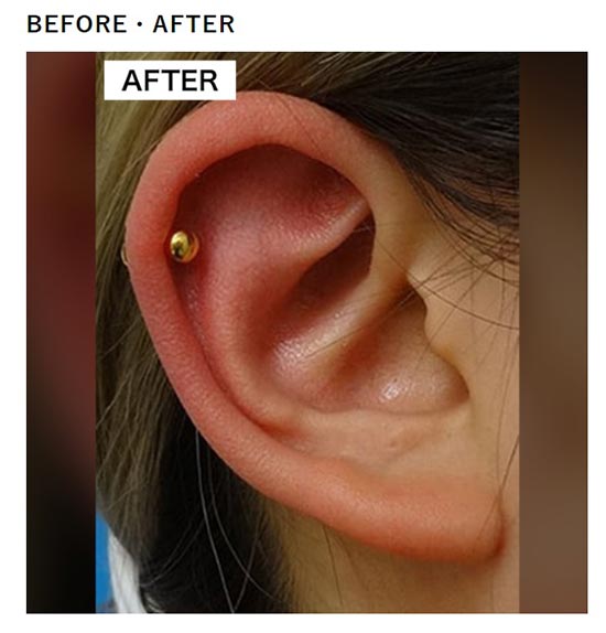 TCB東京中央美容外科の耳・へそのピアス穴開け整形の症例