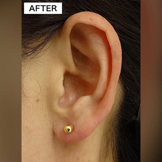TCB東京中央美容外科の耳・へそのピアス穴開け整形（耳たぶ）の症例
