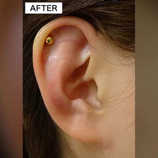 TCB東京中央美容外科の耳・へそのピアス穴開け整形（耳たぶ軟骨）の症例