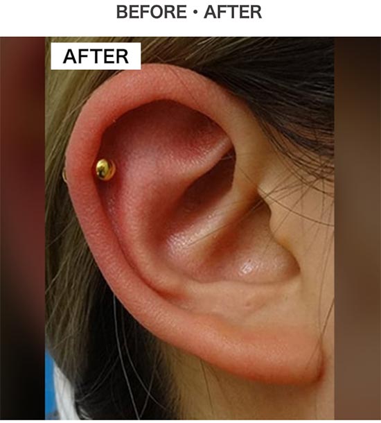 TCB東京中央美容外科の耳たぶピアス穴あけの症例