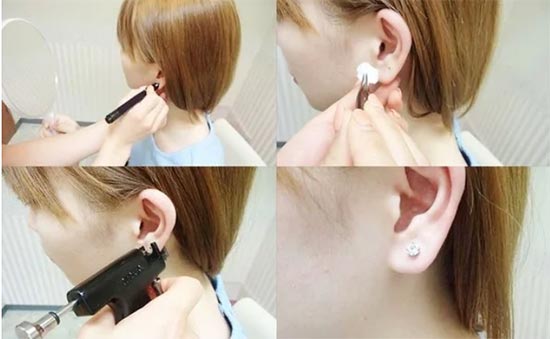 共立美容外科の耳たぶピアス穴あけの症例
