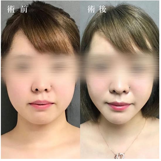 TCB東京中央美容外科のTCB式小顔美肌再生の症例