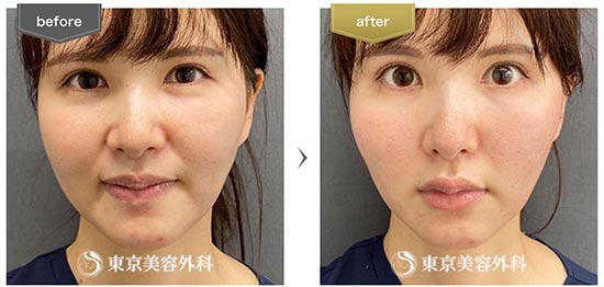 東京美容外科のGコグプレスの症例