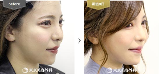 東京美容外科の糸リフト（オルチャンリフト）の症例
