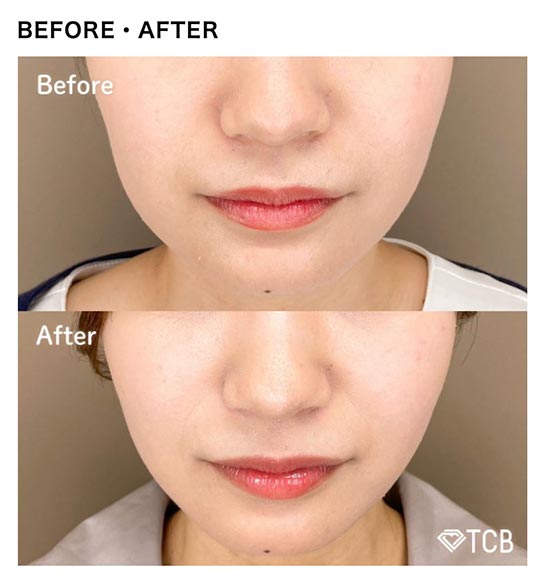 TCB東京中央美容外科のTCB式小顔美肌再生の症例