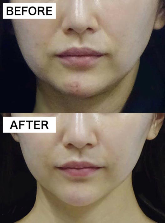 TCB東京中央美容外科のBNLS アルティメット（小顔・部分痩せダイエット注射）の症例