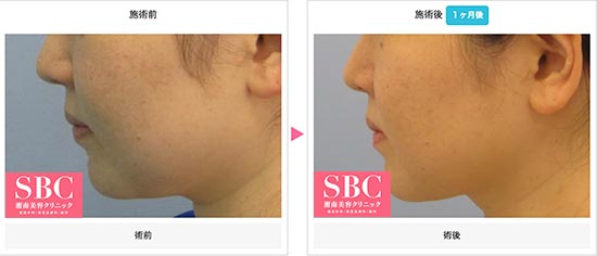 湘南美容クリニックの小顔注射（BNLS neo）の症例