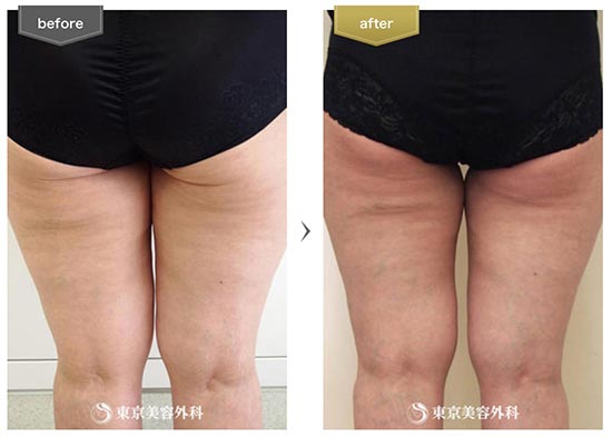 東京美容外科のBNLS注射（臀部・大腿部）の症例