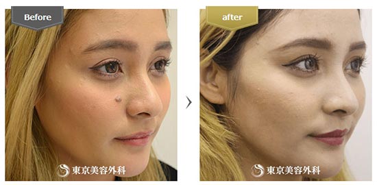 東京美容外科のほくろ除去（切開）の症例