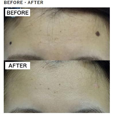 TCB東京中央美容外科のほくろ除去 レーザー治療の症例