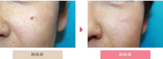 大塚美容外科のほくろレーザー治療の症例