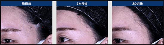 湘南美容クリニックのCO2レーザー（イボ・ほくろ・脂漏性角化症・汗管腫・稗粒腫）の症例