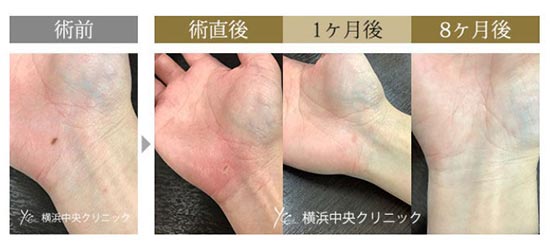 横浜中央クリニックのほくろ除去　エルビウムヤグレーザー										の症例