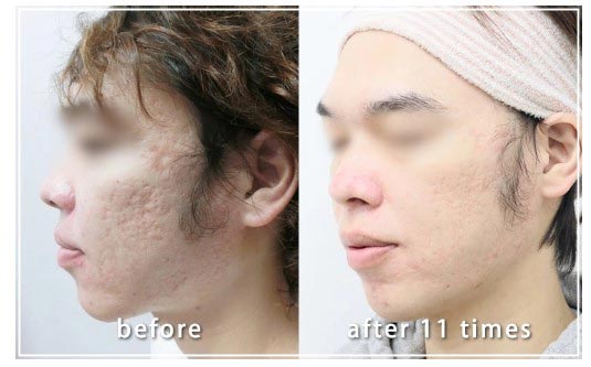 共立美容外科のニキビ跡治療の症例