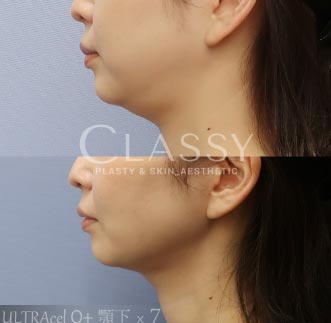 CLASSY 仙台美容外科・美容皮膚科の医療ハイフ(HIFU)の症例