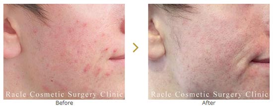 新宿ラクル美容外科クリニックのダーマペン4（頬）の症例