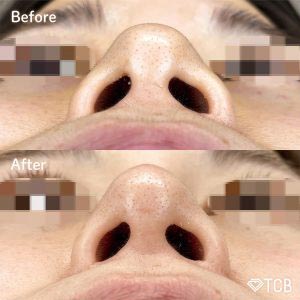 TCB東京中央美容外科の鼻尖形成完全閉鎖法（切らない鼻尖整形）の症例