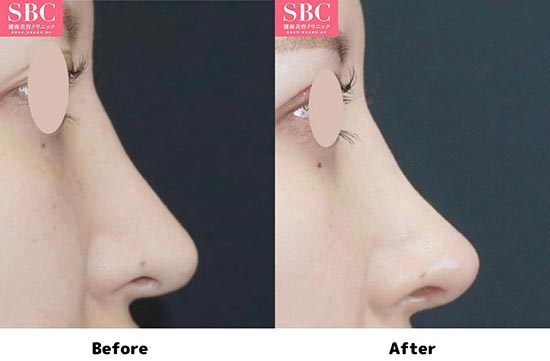 湘南美容クリニックの鼻尖形成術3D法＋軟骨移植＋鼻中隔延長＋中等度修正の症例