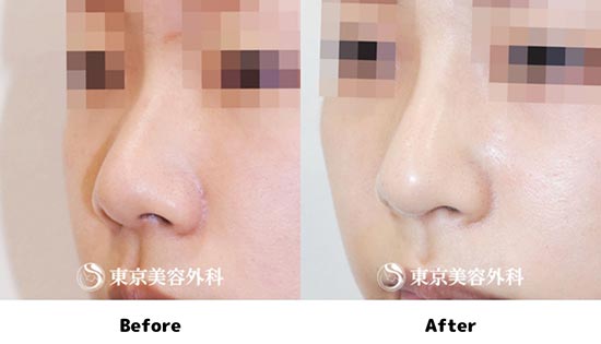 東京美容外科の鼻尖形成（切開法＋軟骨移植）＋隆鼻術（オーダーメードプロテーゼ）の症例