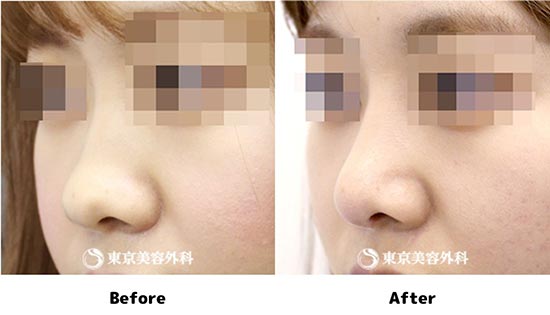 東京美容外科の鼻尖形成（軟骨移植）の症例