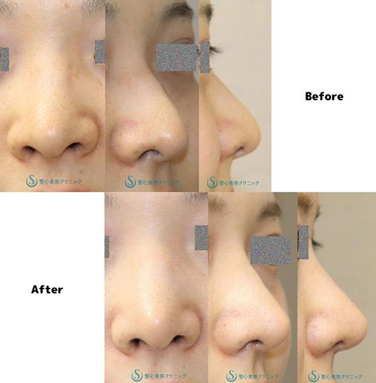 聖心美容クリニックの鼻尖縮小＋鼻尖形成（耳介軟骨移植）の症例