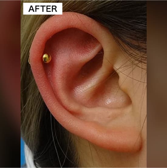 TCB東京中央美容外科の耳・へそのピアスの穴開け整形の症例