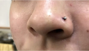 サンライズ美容外科の鼻ピアスノストリルの症例