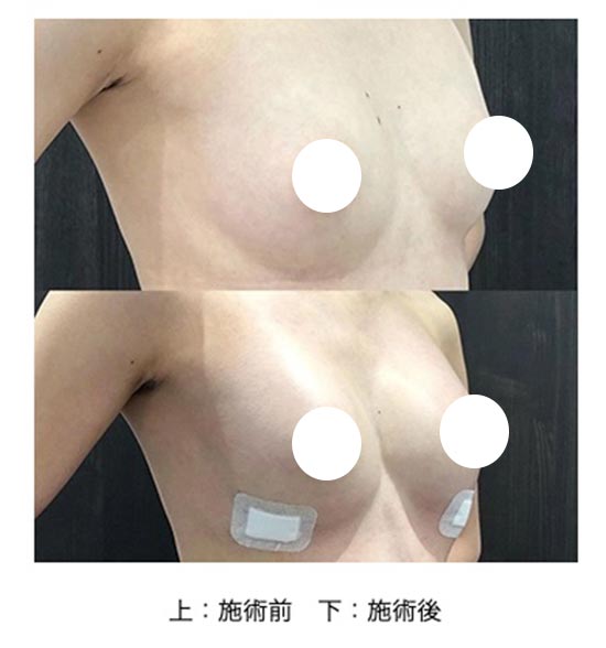 共立美容外科のシンデレラ豊胸術（ヒアルロン酸）の症例