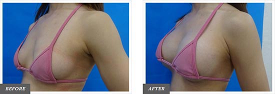 TCB東京中央美容外科のバッグ挿入式豊胸術の症例