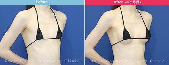 新宿ラクル美容外科クリニックのモティバエルゴノミクスによる豊胸術の症例