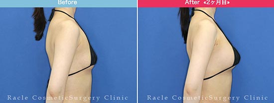 新宿ラクル美容外科クリニックのビューティーフル脂肪注入豊胸の症例