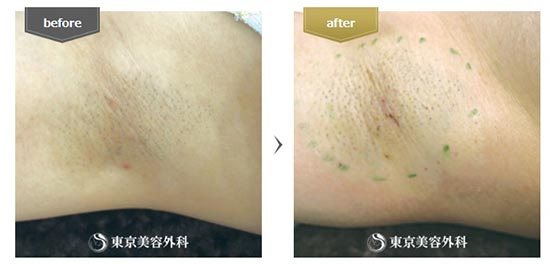 東京美容外科のローラー吸引の症例