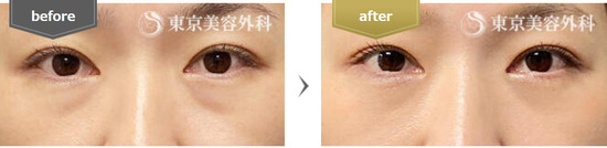 東京美容外科の切らない目の下のクマ・たるみ取り（経結膜アプローチ法）の症例
