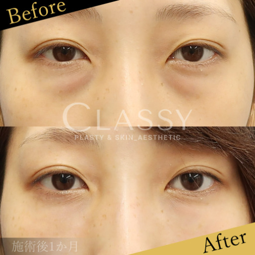 CLASSY 仙台美容外科・美容皮膚科の目の下のふくらみ取りの症例