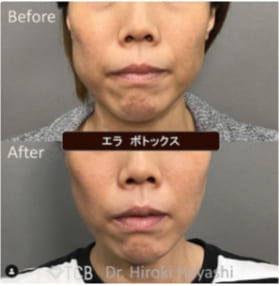 TCB東京中央美容外科のエラボトックス注射の症例