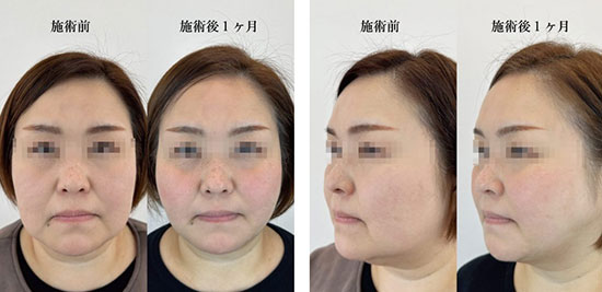 顎下の糸リフト：施術前と1か月後の症例写真【40代女性】