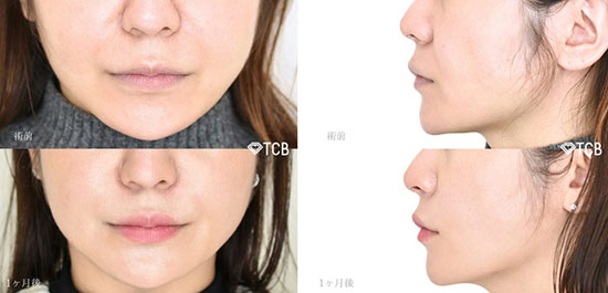 顎下の糸リフト：施術前と1か月後の症例写真【30代女性】