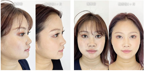 顎下の糸リフト：施術前と1か月後の症例写真【20代女性】