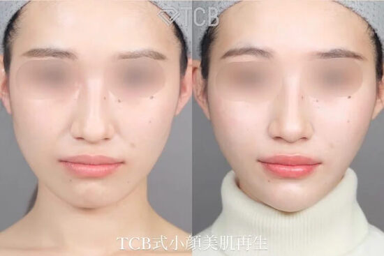 TCB東京中央美容外科のTCB小顔リフトの症例
