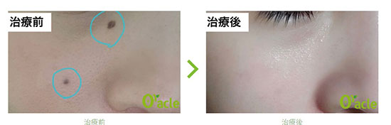 オラクル美容皮膚科のCO2炭酸ガスレーザの症例