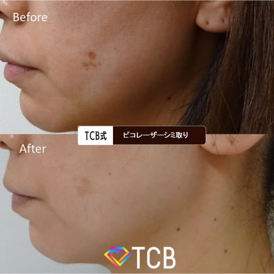 TCB東京中央美容外科のピコレーザーの症例