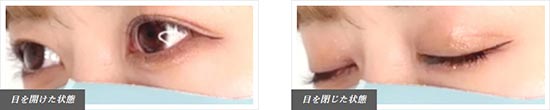 TCB東京中央美容外科のシークレットオプションの症例写真の症例
