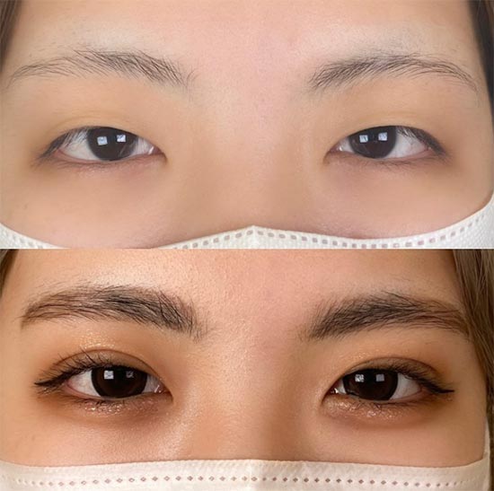 TCB東京中央美容外科の二重整形切開法の症例
