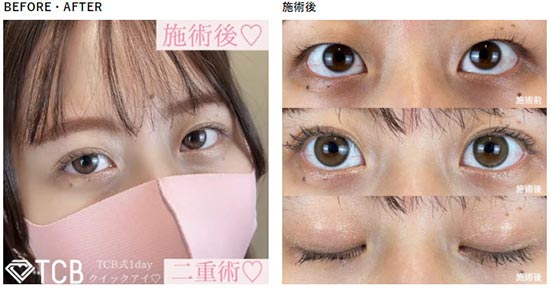 TCB東京中央美容外科の二重整形埋没法の症例