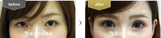 東京美容外科における、まぶたの全切開二重手術に関する成功事例