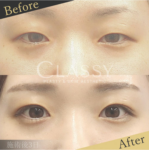 CLASSY 仙台美容外科・美容皮膚科の二重整形（埋没法）の症例