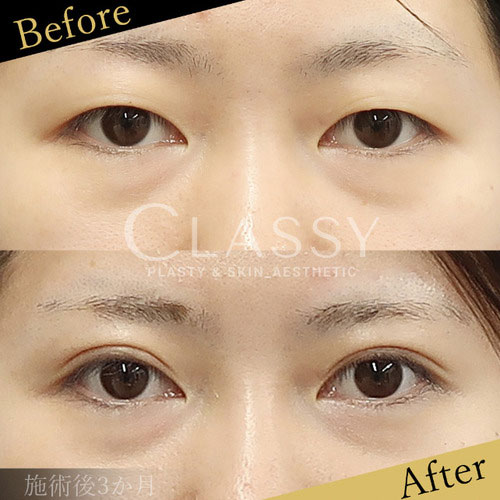 CLASSY 仙台美容外科・美容皮膚科の二重整形（切開法）の症例