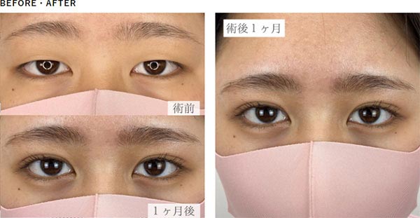 TCB東京中央美容外科の二重整形埋没法の症例